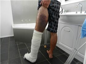 CrackerJack's broken leg