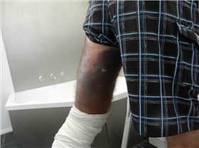 CrackerJack's broken leg