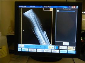 My new leg