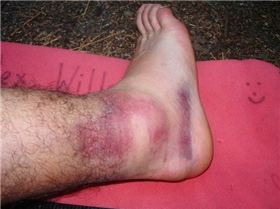 sprainedankle
